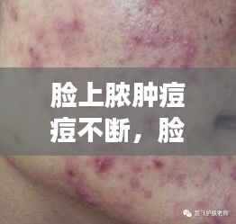 脸上脓肿痘痘不断,脸上脓包痘痘多久才好